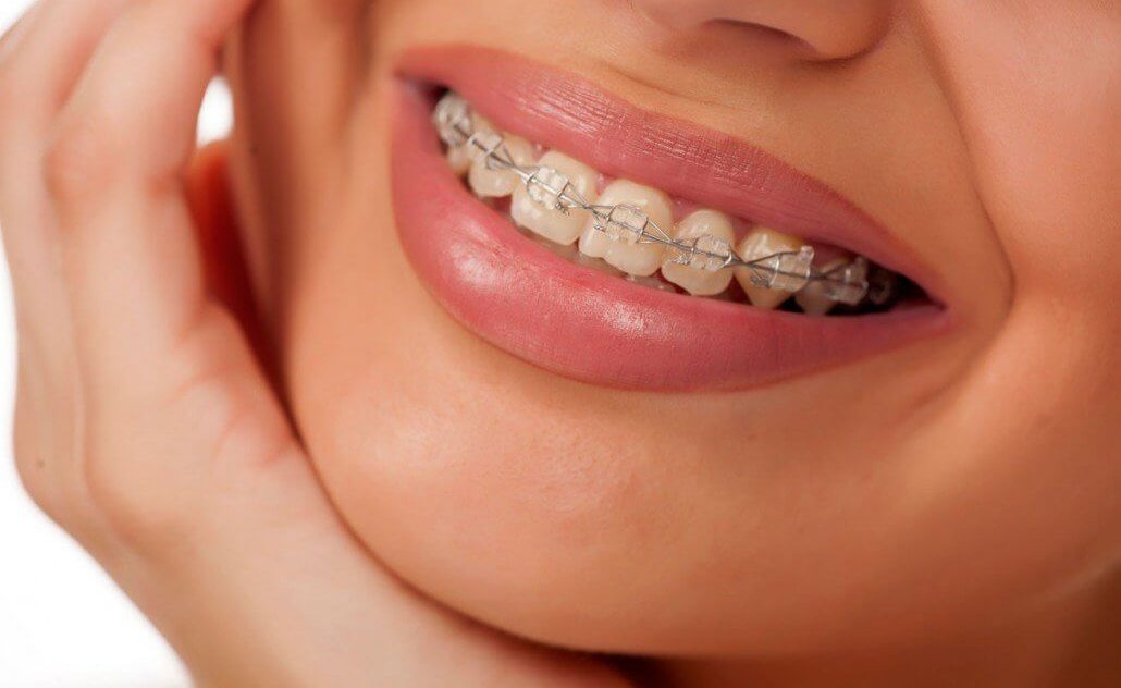 зубы, керамика, улыбка