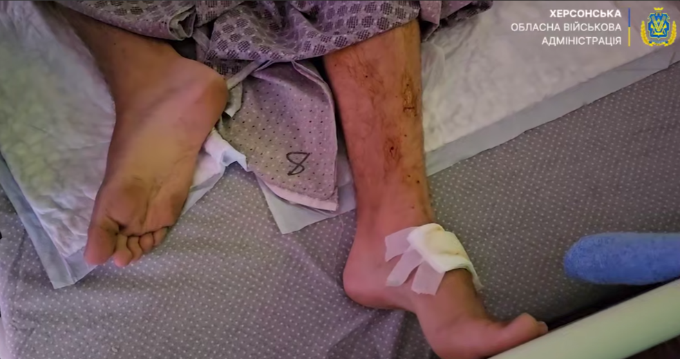 Херсоні, міні, підірвався, 13-річний, Дніпровському, районі, Херсона, стався, вибух, постраждав, підліток, хлопець, їхав, велосипедом, спрацювала, російська, міна, засипають, правобережжя, Херсонщини, протипіхотними мінами